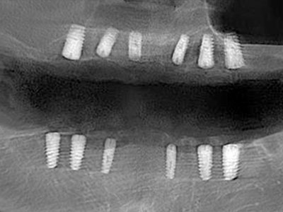 全牙列缺损修复病例