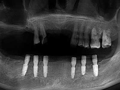 下半口修复病例