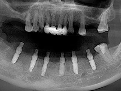下半口修复病例