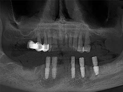 全牙列缺损下半口修复病例